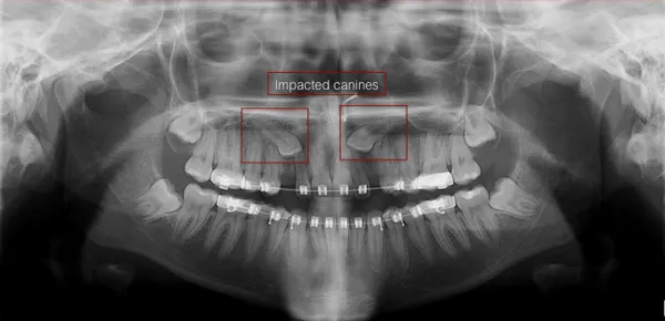 Dental imaging technologies can reveal impacted canines