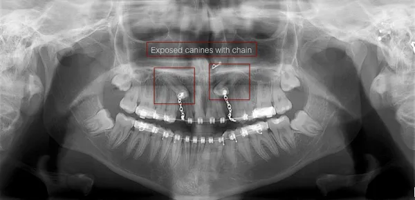 Impacted canines can be bracketed and chained to promote proper alignment