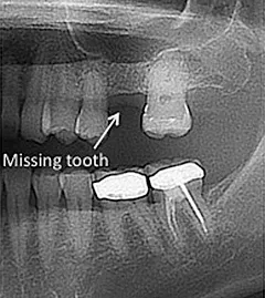 X-ray showing missing tooth for dental implant placement