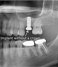 xray showing placement of dental implant