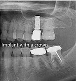 xray of completed dental implant with crown