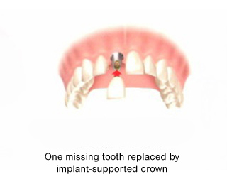 Individual dental implants can replace each missing tooth