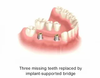 Implant supported bridges can replace multiple teeth
