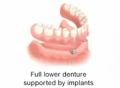 Dentures can be secured by dental implants in the lower jaw