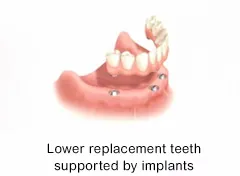 Replacement teeth can be supported by dental implants in the lower jaw