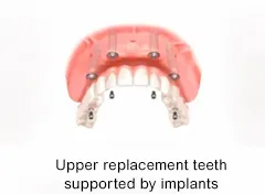 Replacement teeth can be supported in the upper jaw with dental implants