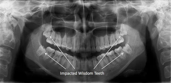Dental imaging technologies can reveal impacted wisdom teeth