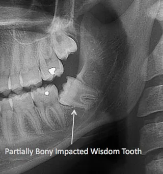 Wisdom teeth can face partially-bony impactions