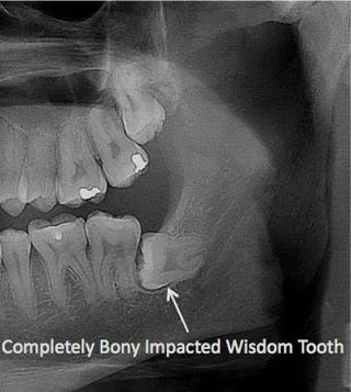 Wisdom teeth can face fully-bony impactions