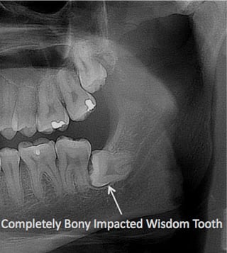 Wisdom teeth can face fully-bony impactions