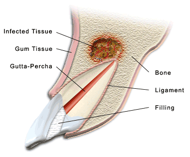 Diagram of Tooth receiving apicoectomy involving the removal of diseased tissues